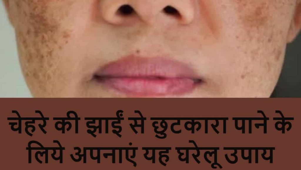 freckles treatment in hindi