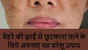 Read more about the article Pigmentation Treatment at Home in Hindi – झाइयों को जड़ से मिटाने के उपाय